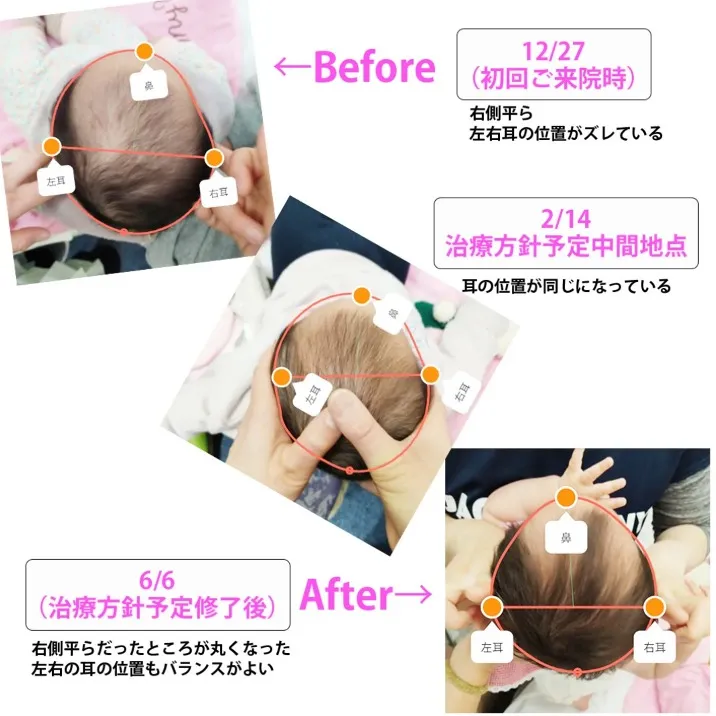 【赤ちゃんケア整体で、右側が平らだった頭がまるく整いました】